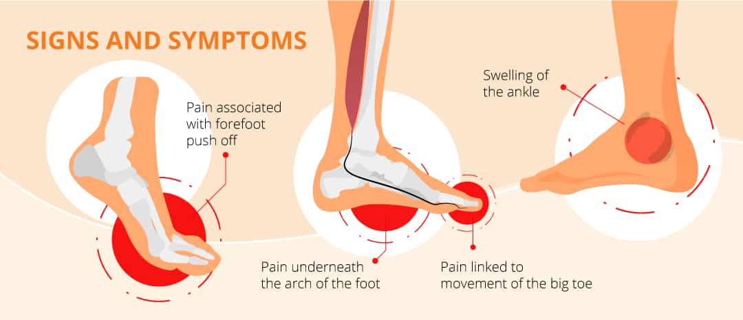 Schmerzen um den Knöchel Teil 2 - Peronealsehnenverletzung