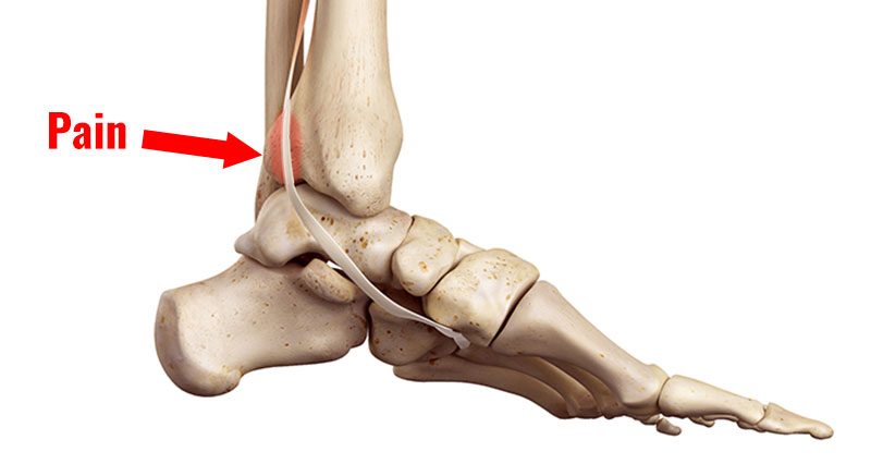 Dor ao redor do tornozelo Parte 5 - Lesões posteriores do tibial